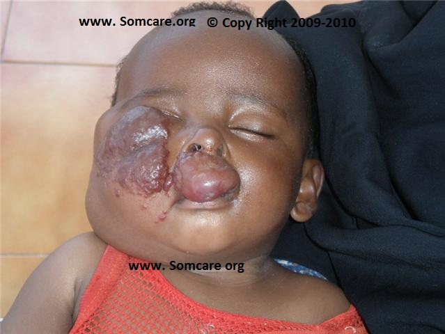 Infant with benign tumour on his right eye and upper lip.